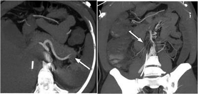 Case Report: A 42-year-old male with IABP developing multiple organ embolism and intestinal necrosis